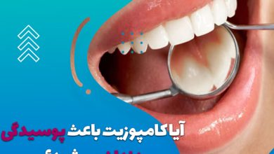 آیا کامپوزیت باعث پوسیدگی دندان میشود؟ (بررسی کامل)