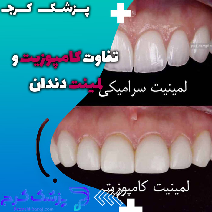 فرق لمینت و کامپوزیت دندان