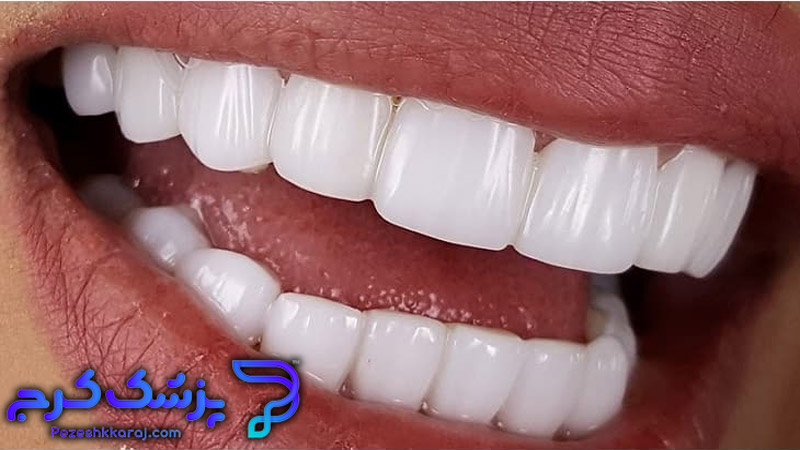 فرق لمینت و کامپوزیت دندان در چیست؟