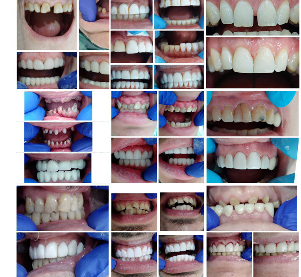 نمونه کامپوزیت دندان کلینیک دندانپزشکی یولیا