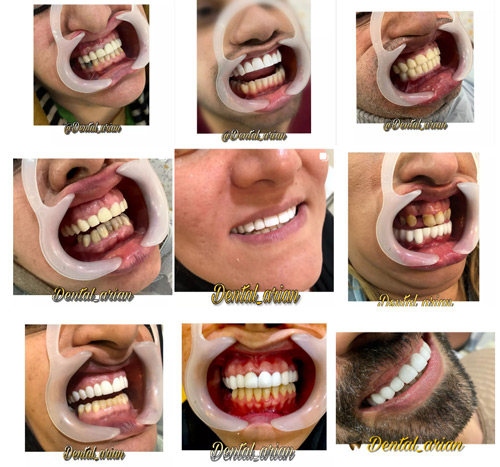 عکس کامپوزیت دندان دندانپزشکی آرین