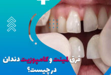 فرق لمینت و کامپوزیت دندان در چیست؟❤️ + [تفاوت قیمت لمینت و کامپوزیت]