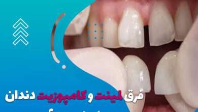 فرق لمینت و کامپوزیت دندان در چیست؟❤️ + [تفاوت قیمت لمینت و کامپوزیت]
